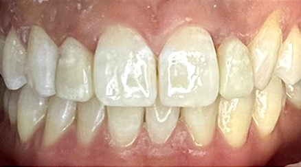 after clear aligners treatment - kaio dental