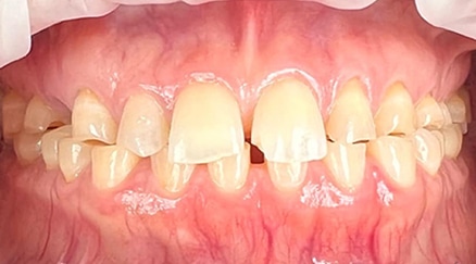 before dental crowns - kaio dental